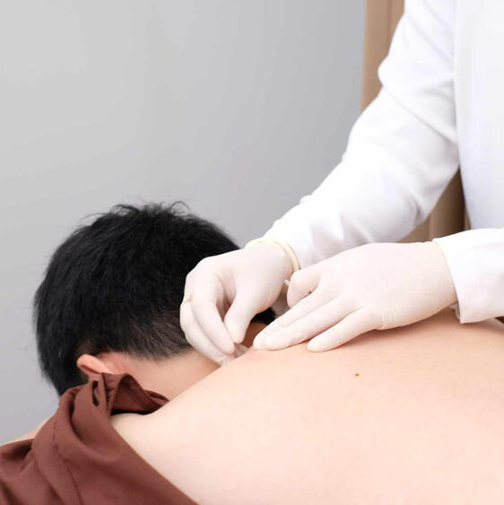 ฝังเข็ม Acupuncture